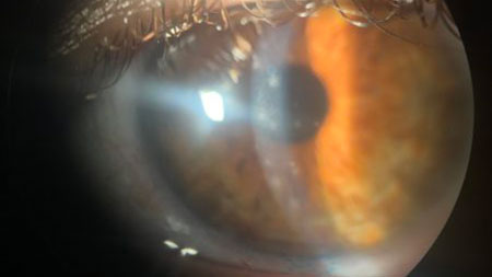 Pacientes com queixas oculares em tempos de Covid-19 - PEBMED