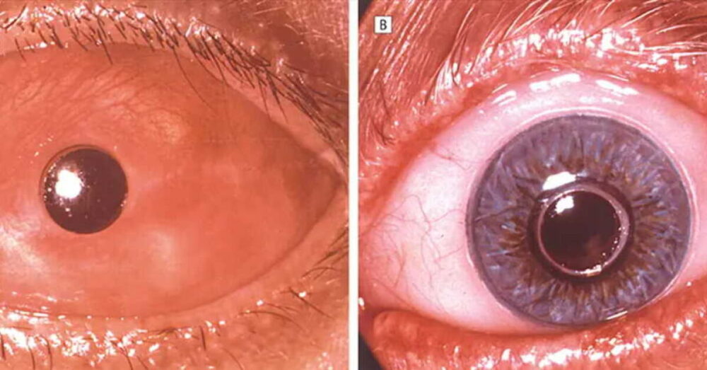 Oftalmologia - Cirurgia dente-no-olho: entenda procedimento - Universo ...